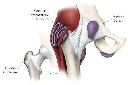 trochanteritis01