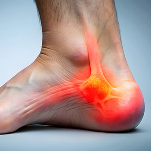 Πελματιαία Απονευρωσίτιδα - Άκανθα Πτέρνας